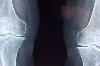 Como são feitos os tratamentos para Tumores Ósseos?