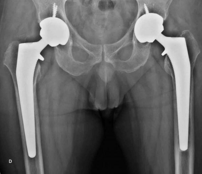 Artroplastia total de quadril bilateral