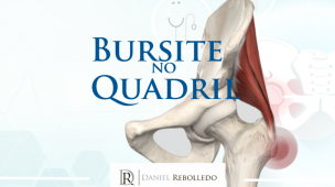 A Bursite no Quadril ou bursite trocantérica é uma das principais causas de dor no quadril