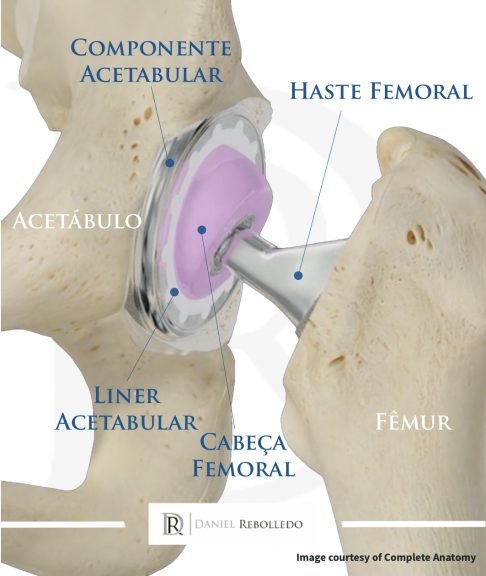 Protese de quadril implantada na articulação