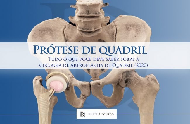 PROTESE DE QUADRIL: Guia Completo sobre a cirurgia de artroplastia de quadril (2021)