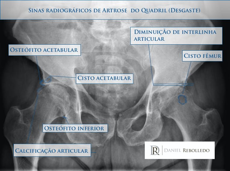 Protese De Quadril Guia Completo Sobre A Cirurgia De Artroplastia De Quadril 2021 Blog Dr 3134