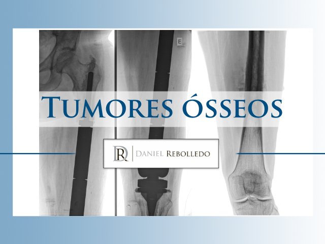 Tumor ósseo