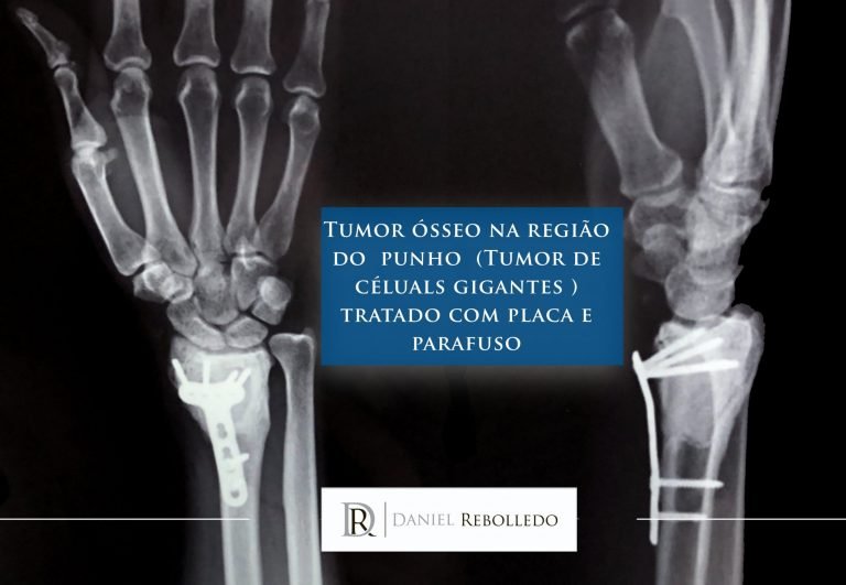 Tumor ósseo: Tumor d células gigantes operado e reconstruído com placa e cimento ortopédico