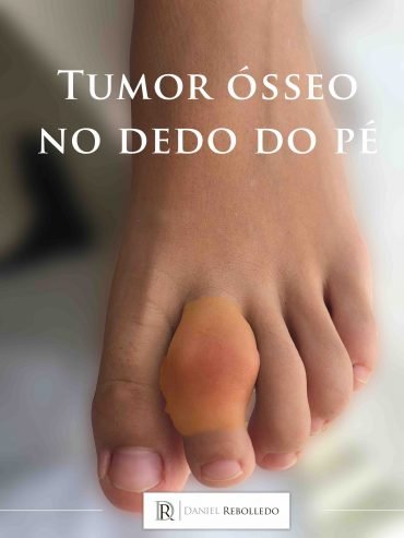 Tumor ósseo no pé