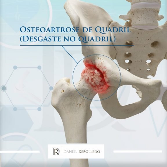 Protese De Quadril Guia Completo Sobre A Cirurgia De Artroplastia De Quadril 2021 Blog Dr 2736