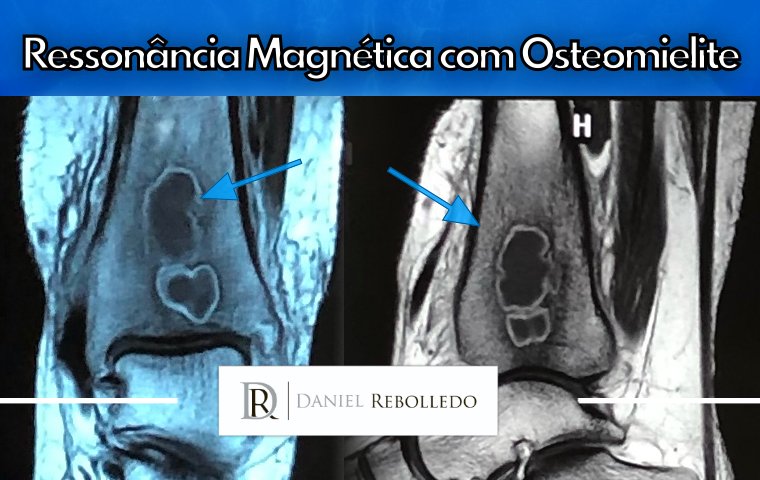 resonancia magnetica osteomielite