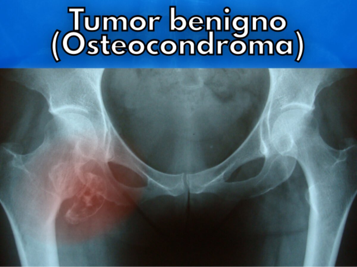 O que é osteocondroma? | Blog | Dr. Daniel Rebolledo