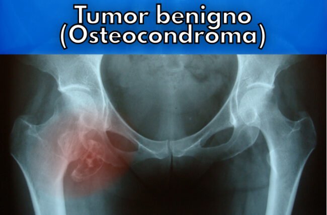 O que é osteocondroma?